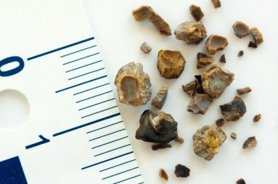 ​结石不能吃什么（注意：各类结石患者分别有几种食物要少吃，别等到出事了才后