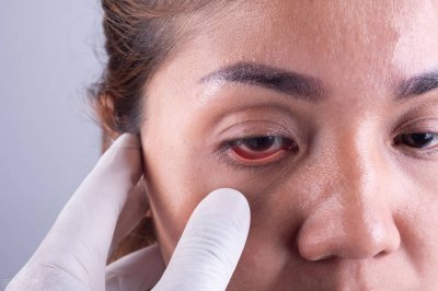 ​去眼袋手术效果 眼袋很大，做手术能够一劳永逸地解决吗？医生告知答案，值得收