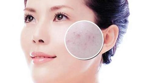 春天脸上长痘痘怎么办 脸上长痘痘是什么原因 春天脸上长痘痘怎么办 脸上长痘痘是什么原因