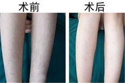 ​汗毛多怎么去除 汗毛多是什么原因