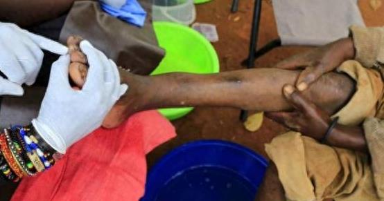 这里的人脚底“千疮百孔”，背后“元凶”让他们痛苦不堪