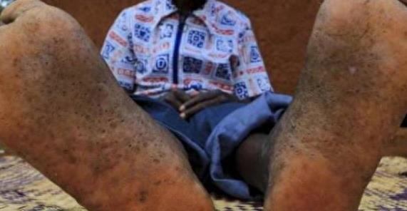 这里的人脚底“千疮百孔”，背后“元凶”让他们痛苦不堪