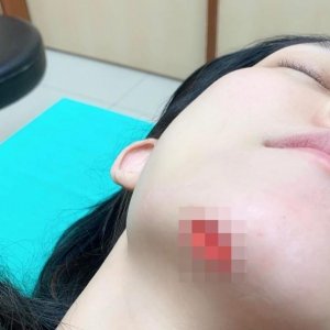 ​范玮琪摔倒撞伤下巴缝15针 皮肉外翻超恐怖