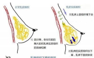 ​产后怎样防止乳房下垂(产后如何预防乳房下垂)
