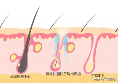 ​毛孔严重堵塞怎么办（这几招教你解决毛孔堵塞）
