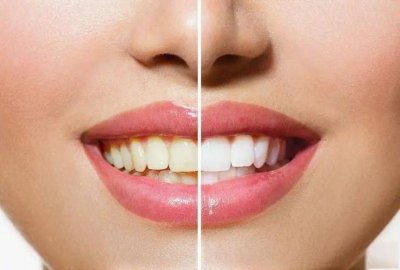 ​健康的牙齿应该是什么颜色（真正健康的牙齿是什么颜色）