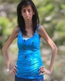 女子高1.57米体重54斤，被称为“骷髅女孩”