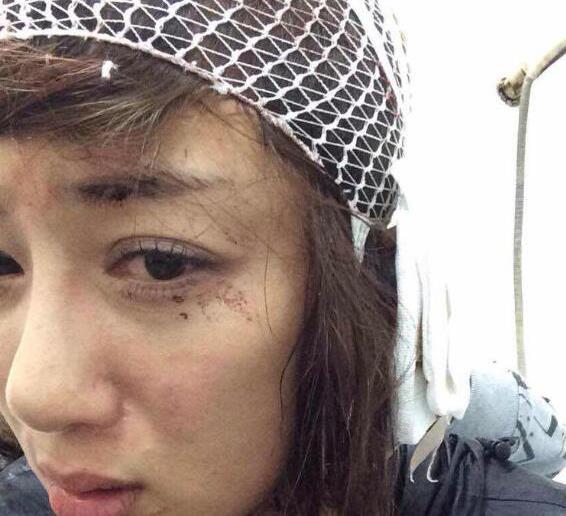 叶璇狗咬事件再度翻出，李依晓近年频繁“换脸”是因为容貌受损？