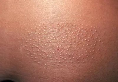 ​一小块皮肤粗糙像磨砂 是什么原因？