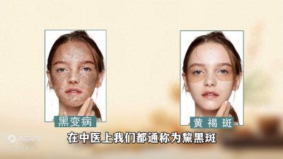 ​都叫黧黑斑，但不是一种病，你知道吗？