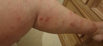 ​英女子住一晚酒店被跳蚤咬了七十下，伤口感染后称觉得血液在沸腾