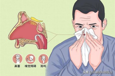 ​健康科普：带你了解什么是“鼻息肉”