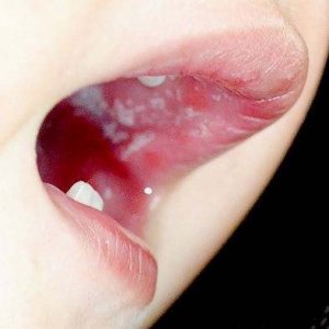 ​宝宝鹅口疮，你听说过没？