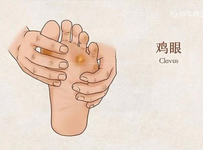 ​“鸡眼”到底是怎么回事？有了鸡眼应该如何正确处理？