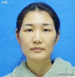 ​女生颧骨高就一定不好看吗？错，颧骨高也好看，不好看是颧骨高耸